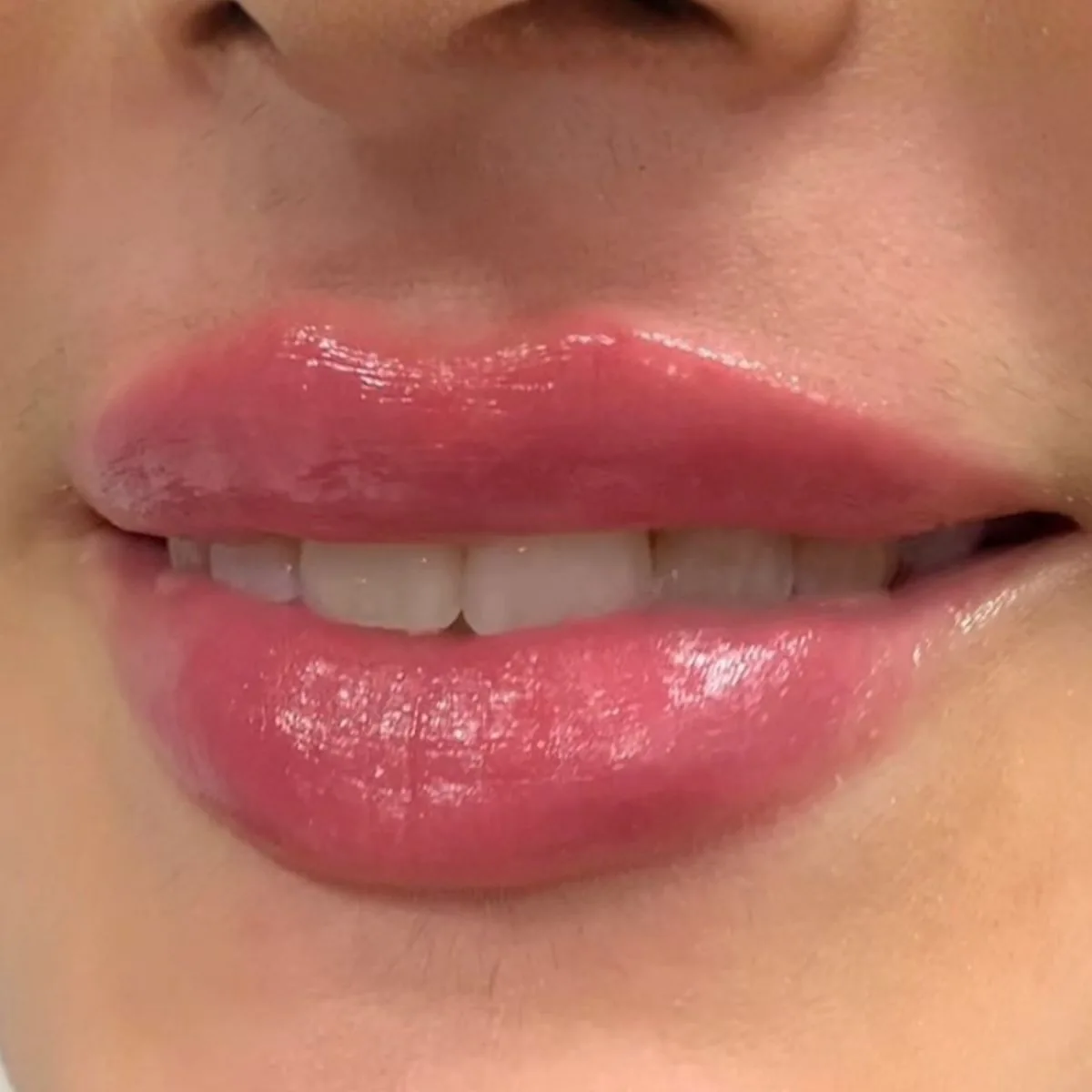 Povečanje ustnic SM Lips, pred in po
